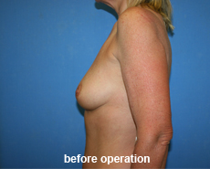 plastic-surgery-breast-augmentation
